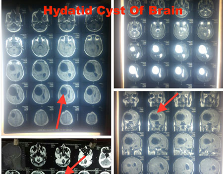 Brain Surgery